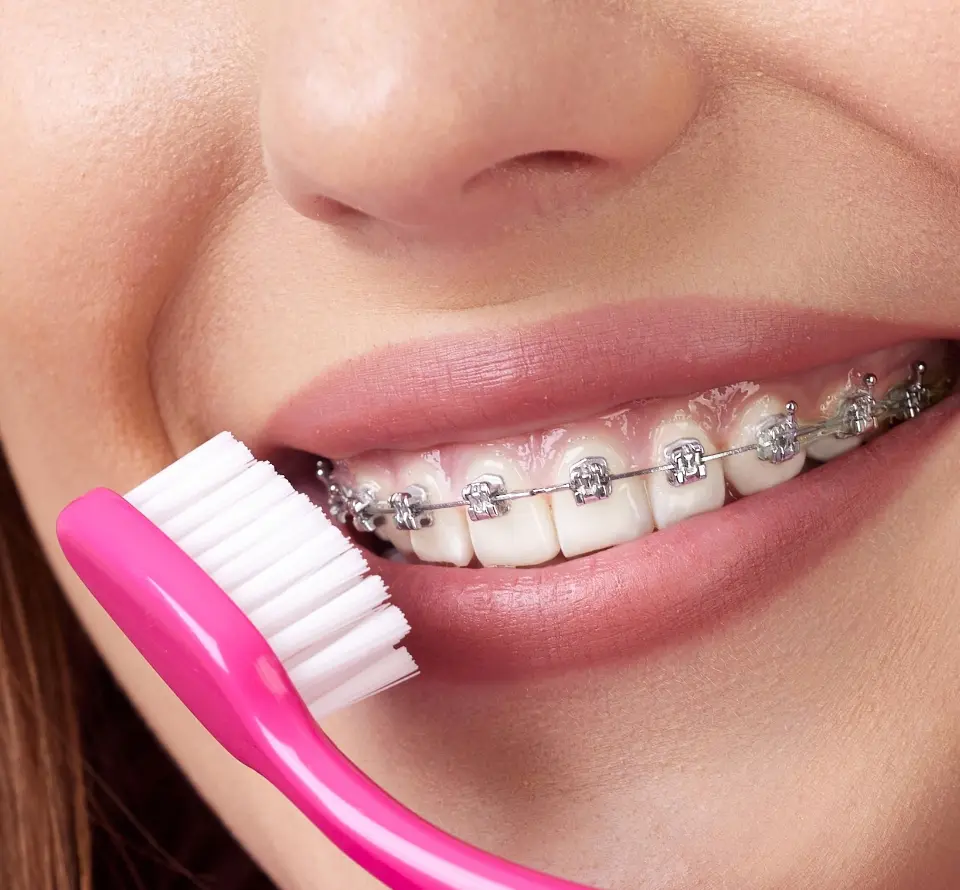 Brushing with Braces