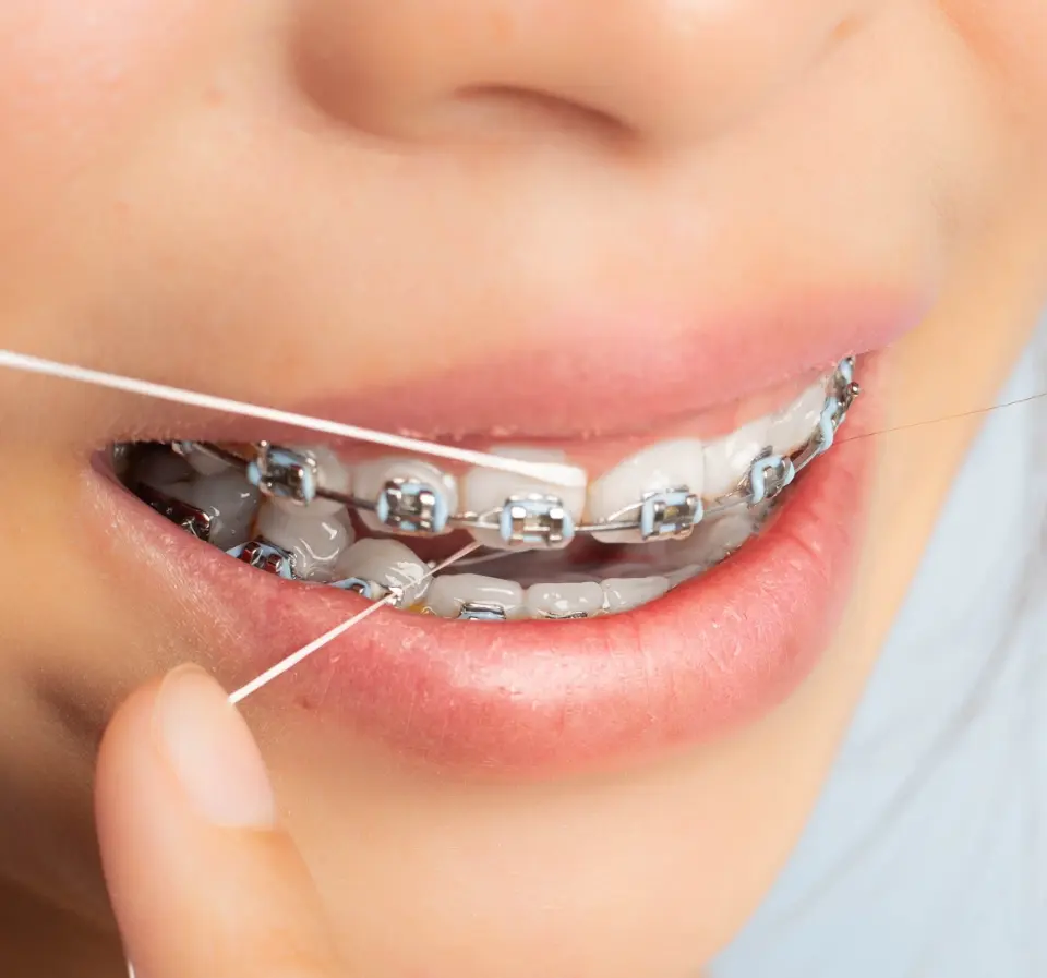 Flossing with Braces