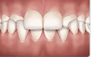 Crossbite icon