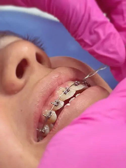 Person receiving dental care. Close-up of a mouth with braces being adjusted. Pink gloved hands work carefully, conveying a clinical, focused atmosphere.