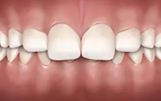 Overbite icon