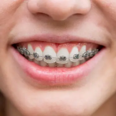 person smiling with braces